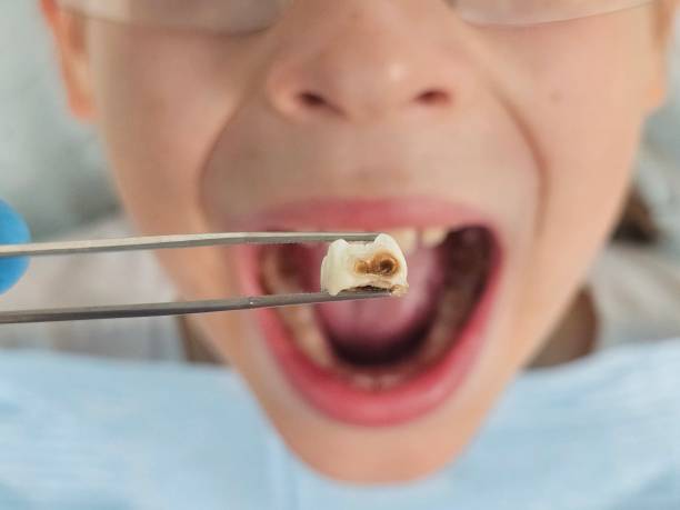 Best Emergency Dental Care for Abscessed Tooth in Kemah, TX